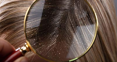 Your Guide to Treating Dandruff